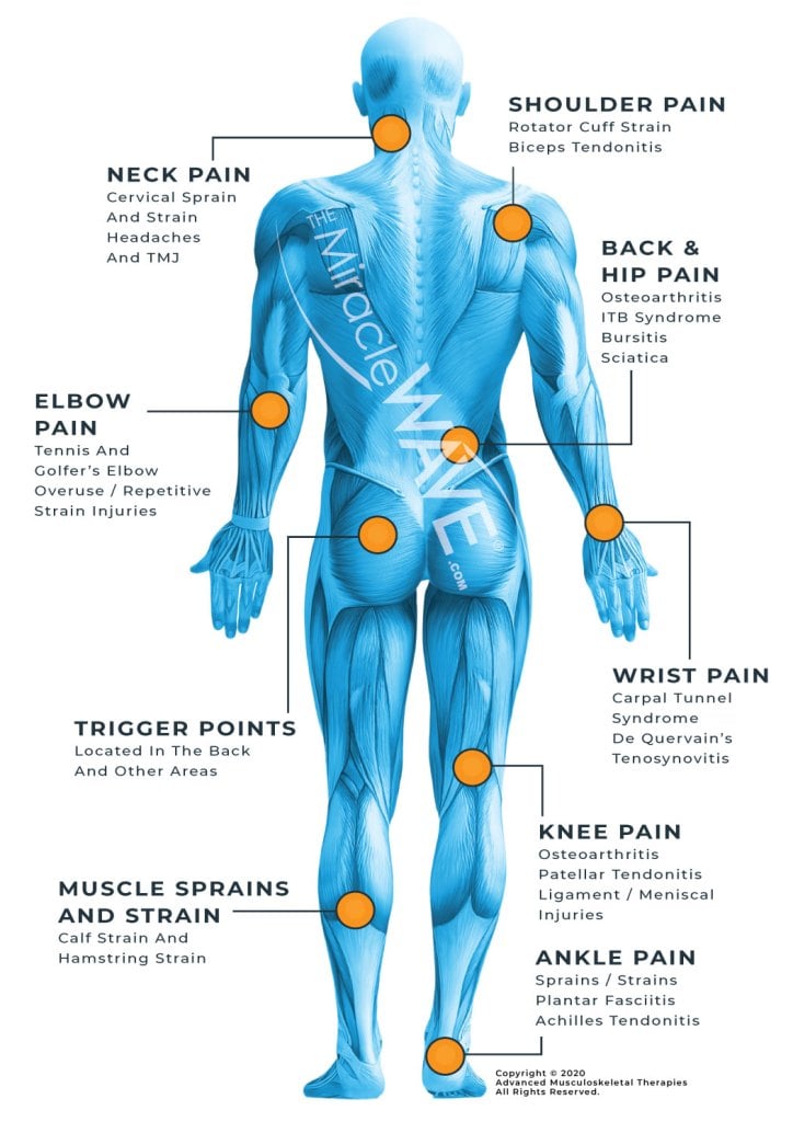 Extracorporeal Shock Wave Therapy—Application for Trigger Points